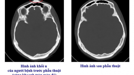 Phẫu thuật thành công ca u xương sọ hiếm gặp từ triệu chứng mơ hồ 