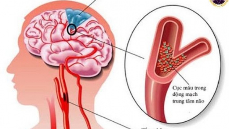 Cứ 3 giây có 1 người bị đột quỵ trên toàn cầu