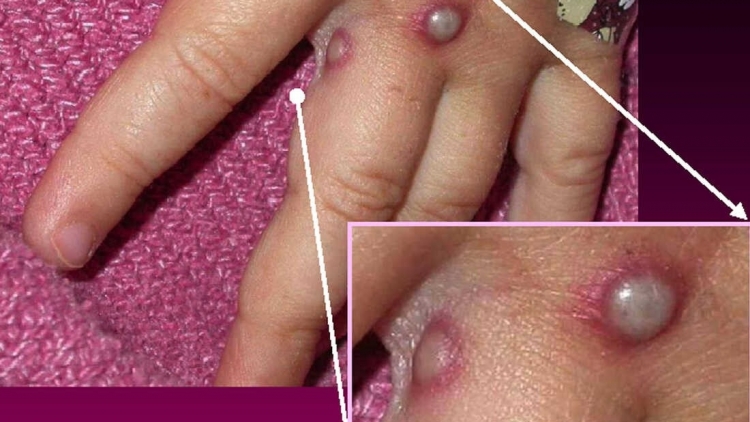 Thái Lan cảnh báo bệnh đậu mùa khỉ.
