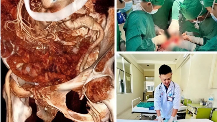 Phẫu thuật cứu sống cụ bà vỡ phình động mạch chủ bụng