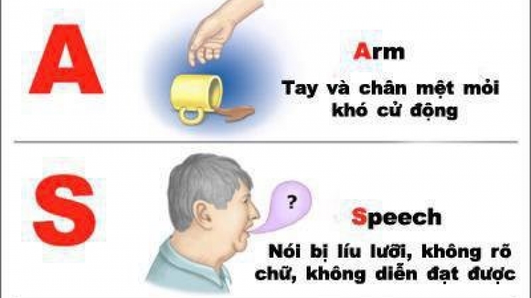 Điều trị kịp thời cho bệnh nhân đột quỵ 