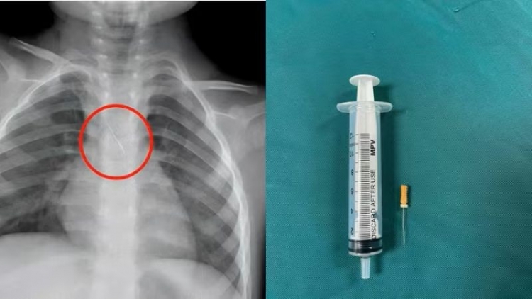Kịp thời cứu cháu bé bị kim chọc tủy rơi vào đường thở