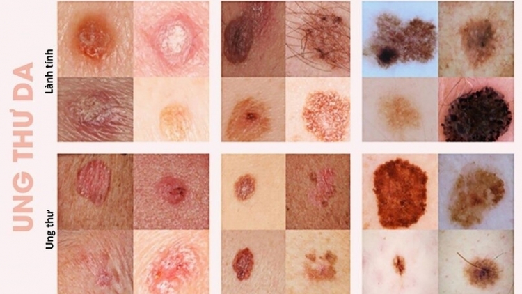 Ung thư tế bào hắc tố: Phát hiện sớm là "chìa khòa vàng" trong điều trị