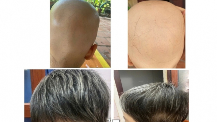 Điều trị thành công ca rụng tóc toàn bộ da đầu cho bệnh nhân 7 tuổi
