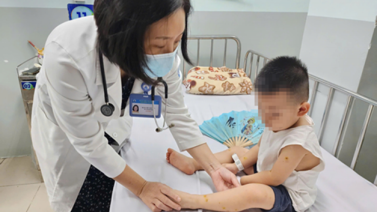 Cả nước ghi nhận gần 54.000 trường hợp mắc bệnh tay chân miệng