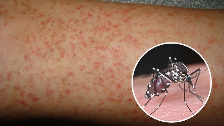 Gia tăng bệnh sốt xuất huyết Dengue nặng tại đồng bằng Sông Cửu Long