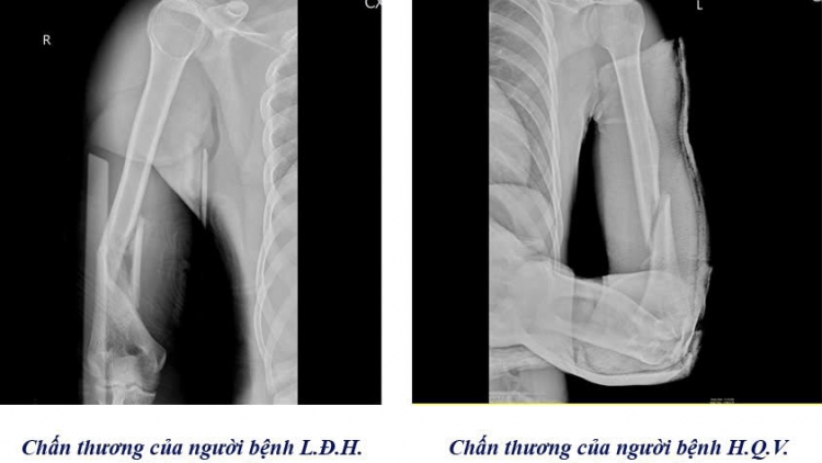 Cảnh báo nguy cơ gãy tay từ trò chơi vật tay