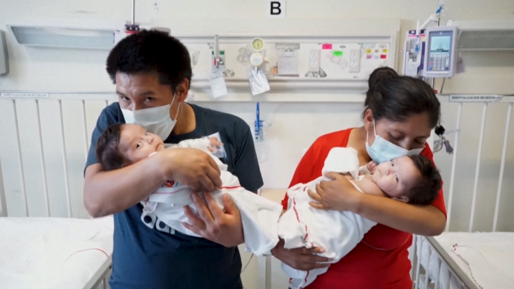 Peru: phẫu thuật tách rời thành công cặp song sinh dính liền