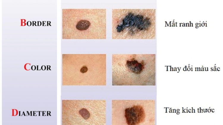 Ung thư tế bào hắc tố: Ung thư da tiềm ẩn từ tổn thương không đau, không ngứa