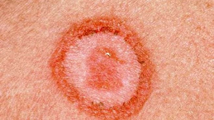 Khuyến cáo từ trường hợp trẻ mắc giang mai bẩm sinh