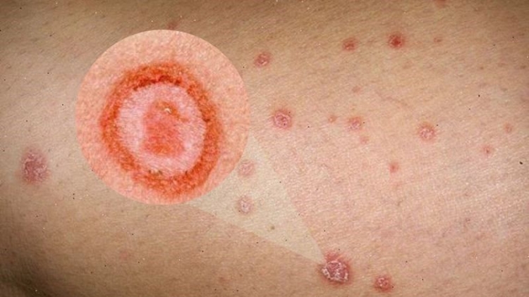 Mắc giang mai từ quan hệ tình dục không an toàn