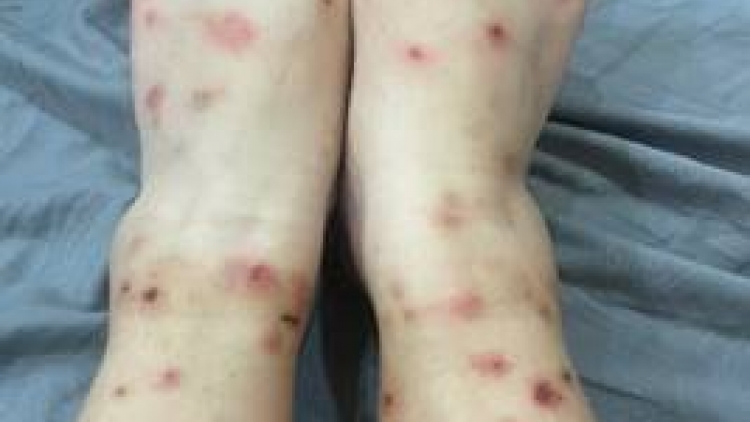 Mùa hè: Phòng ngừa viêm da do bọ chét