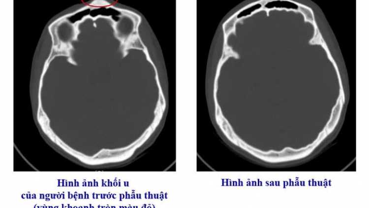 Phẫu thuật thành công ca u xương sọ hiếm gặp từ triệu chứng mơ hồ 