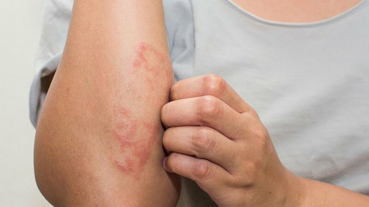 Từ tổn thương ngoài da phát hiện bệnh viêm mạch hiếm có thể gây suy đa cơ quan