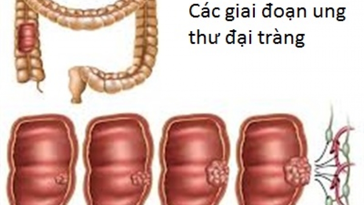 Phương pháp mới điều trị ung thư đại trực tràng giúp giảm độc tính hóa trị, giảm tác dụng phụ, đáp ứng với quá trình chữa trị tốt hơn. (Thời sự đêm 31/01/2018)