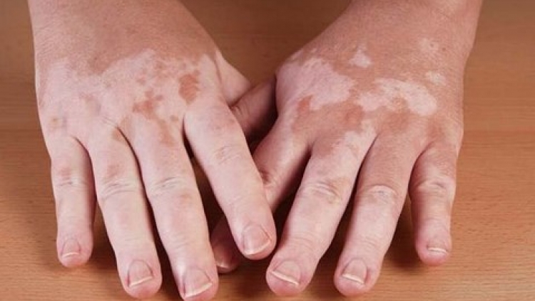 Bát nháo thị trường thuốc chữa bệnh bạch biến (20/12/2018)