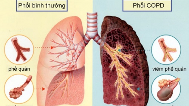 Bệnh phổi tắc nghẽn mạn tính và những điều cần biết (23/12/2018)