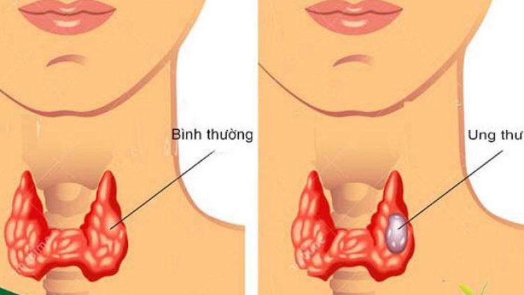 Tư vấn về điều trị bệnh ung thư tuyến giáp (2/12/2019)