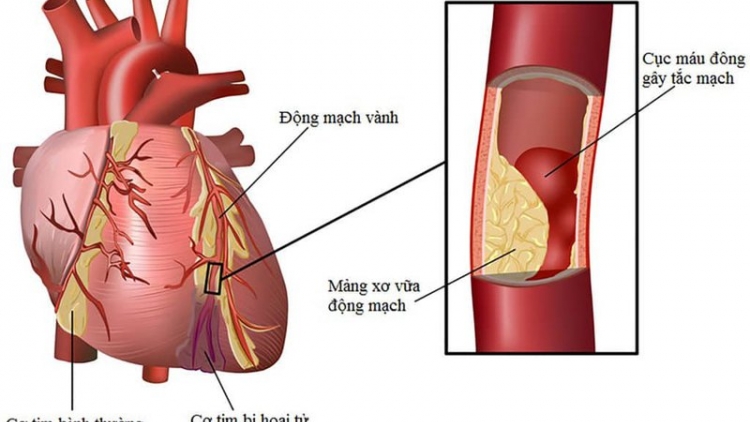 Tư vấn cách chăm sóc sức khỏe để phòng ngừa bệnh tim mạch (9/3/2020)