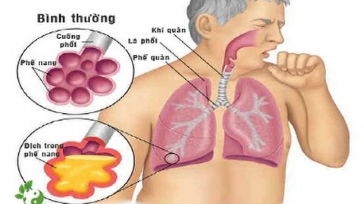 Tìm hiểu về bệnh viêm phế quản và thủ phạm thuốc lá (1/3/2020)