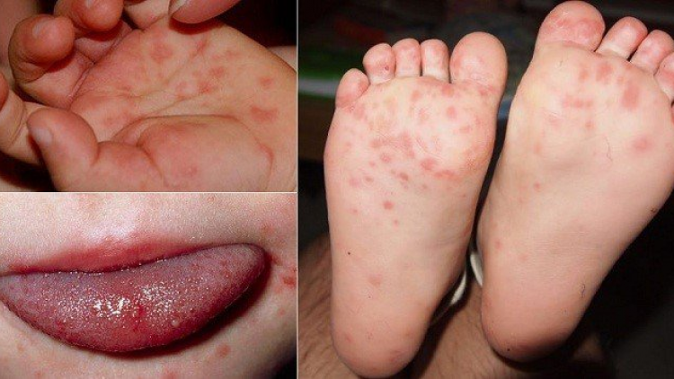 Lâm Đồng: 11 trẻ phải nghỉ học vì mắc bệnh tay chân miệng (15/9/2020)