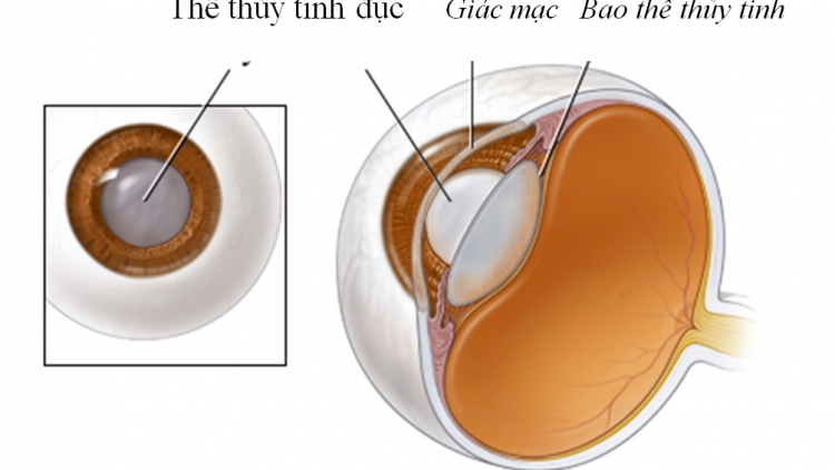 Cách phòng tránh bệnh đục thủy tinh thể do lạm dụng thuốc chống viêm (21/01/2021)