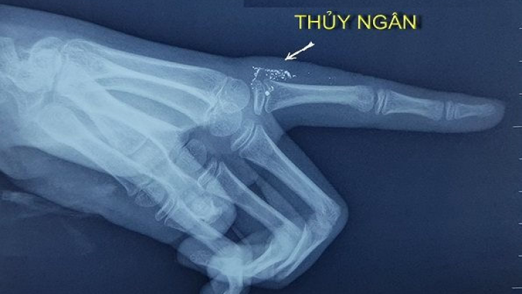 Bé gái 11 tuổi bị nhiễm độc thủy ngân do vỡ nhiệt kế (01/03/2021)