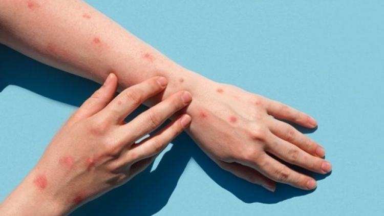 Indonesia phát hiện 7 ca mắc Đậu mùa Khỉ lây nhiễm trong cộng đồng (25/10/2023)