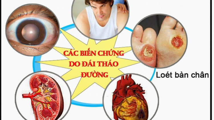 Chuyên gia cảnh báo người bệnh tuyệt đối không chủ quan với các biến chứng (05/03/2023)