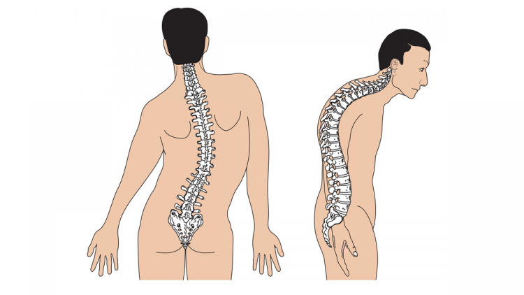 Tư vấn các bệnh gù vẹo cột sống (27/5/2023)