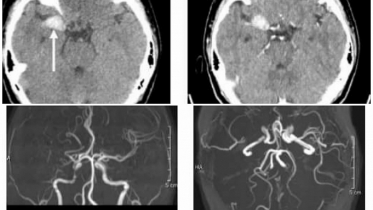 Nữ sinh 18 tuổi bị đột quỵ hiếm gặp, y văn thế giới chỉ có vài trường hợp (05/02/2024)