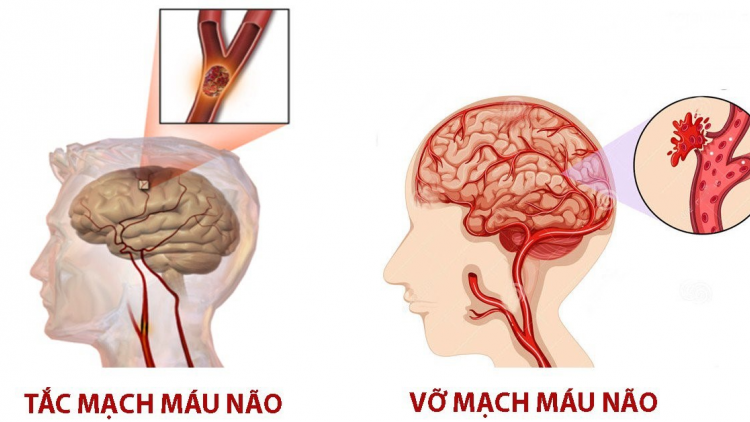 Phòng ngừa, điều trị bệnh đột quỵ ngày càng trẻ hóa (27/7/2024)