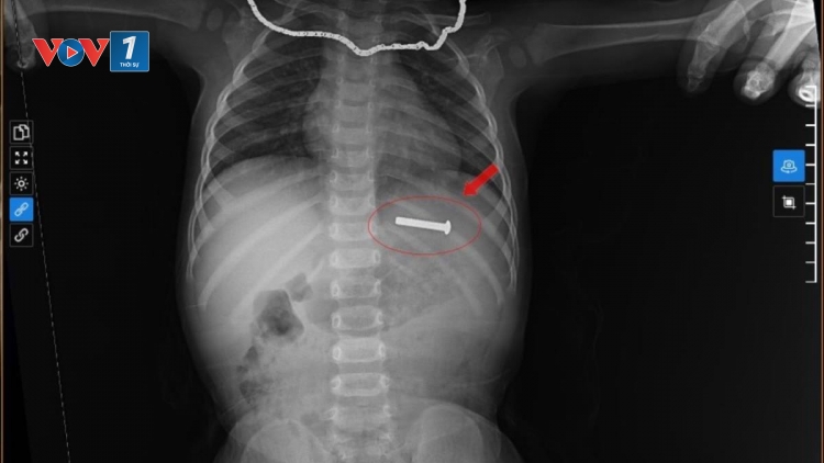 Gắp thành công đinh vít dài 5cm ra khỏi dạ dày bệnh nhi 15 tháng tuổi