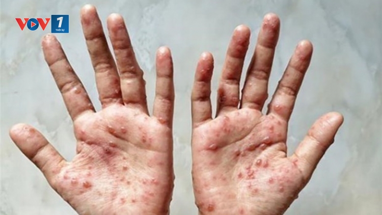 WHO duy trì tình trạng khẩn cấp y tế toàn cầu với bệnh đậu mùa khỉ