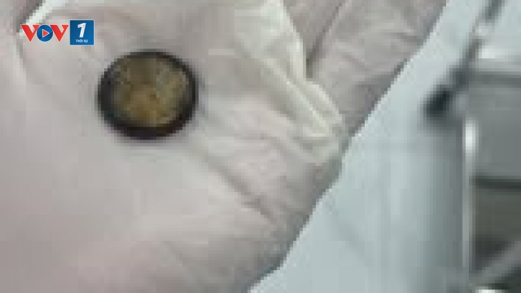 Hà Nội: Bệnh nhi 4 tuổi loét thực quản vì nuốt phải pin cúc áo (11/03/2025)