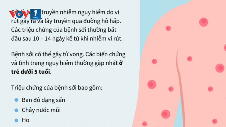 Phổ biến Bộ tài liệu truyền thông về bệnh sởi của Tổ chức Y tế Thế giới (22/03/2025)