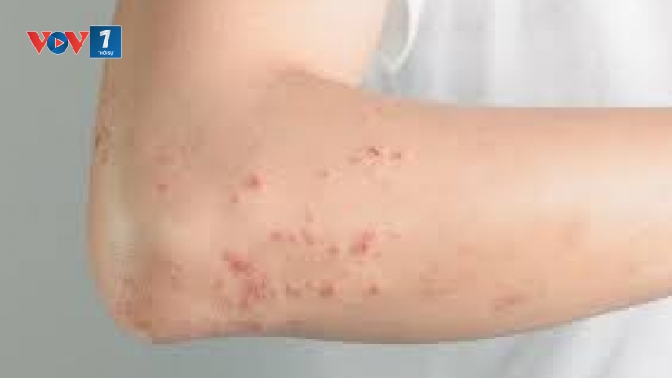 Cảnh giác các biến chứng bệnh sởi ở người lớn