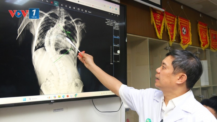 Điều trị, can thiệp bệnh lý gù, vẹo cột sống 