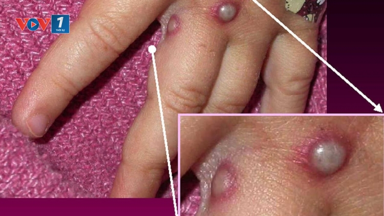 Thái Lan cảnh báo bệnh đậu mùa khỉ.