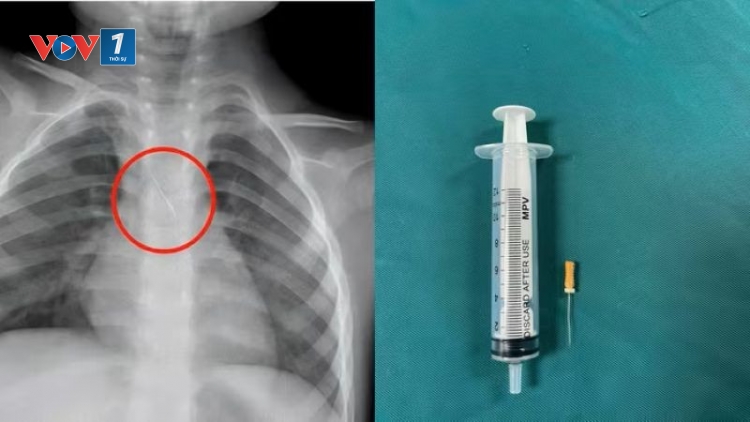 Kịp thời cứu cháu bé bị kim chọc tủy rơi vào đường thở