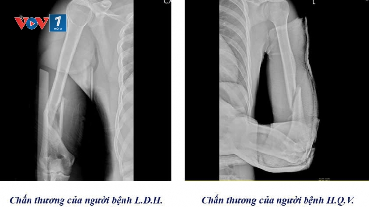 Cảnh báo nguy cơ gãy tay từ trò chơi vật tay