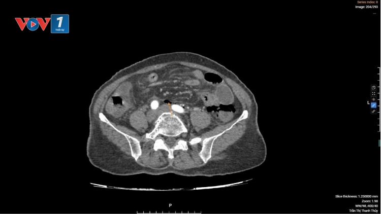 Giành lại sự sống từ ca thủng đại tràng hiếm gặp