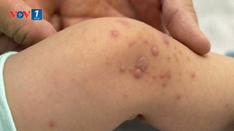 Cảnh báo virus EV71 khiến trẻ mắc tay chân miệng chuyển nặng, gia tăng nguy cơ tử vong