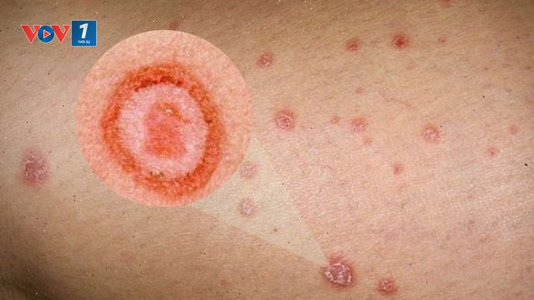 Mắc giang mai từ quan hệ tình dục không an toàn