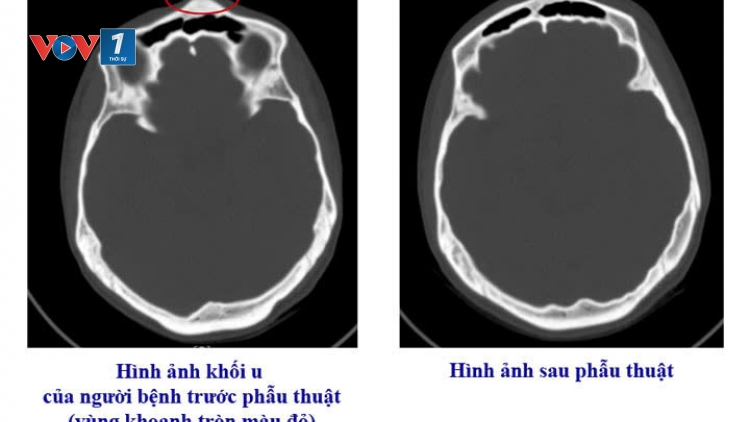 Phẫu thuật thành công ca u xương sọ hiếm gặp từ triệu chứng mơ hồ
