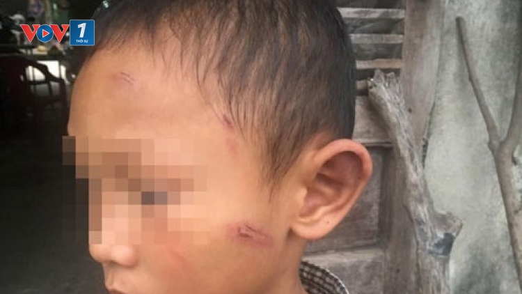 Công an tỉnh Quảng Ngãi đang điều tra vụ cháu bé 5 tuổi bị chính người thân bạo hành gây thương tích (Thời sự đêm 11/5/2017)