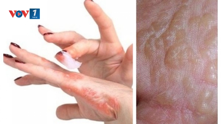 Bệnh viêm da cơ địa và cách điều trị bệnh (25/5/2019)