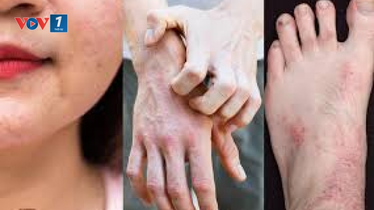 Bệnh viêm da dị ứng vào mùa hè: Nguyên nhân và hướng điều trị (22/6/2019)