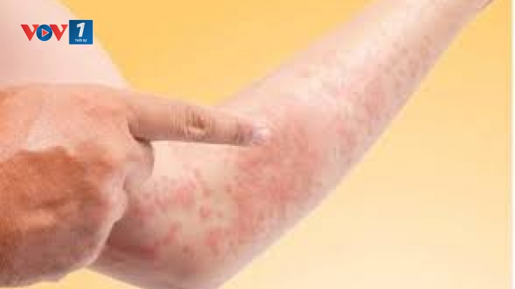 Tìm hiểu về bệnh mề đay mùa nắng nóng (20/7/2019)