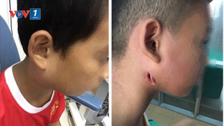 Bệnh do vi khuẩn Whitmore: Kiểm soát bệnh từ ý thức của mỗi người (21/9/2019)